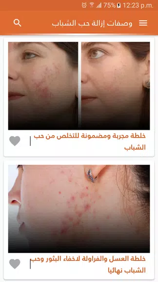 وصفات لازالة حب الشباب بدون نت स्क्रीनशॉट 2