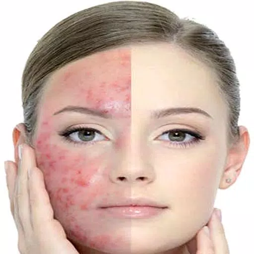 Get Rid of Acne  (Guide) Capture d'écran 2